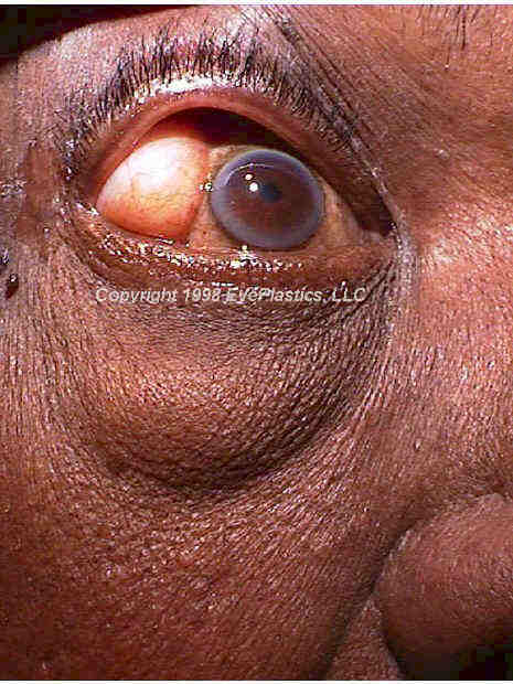 This image shows a herniated orbital fat condition.